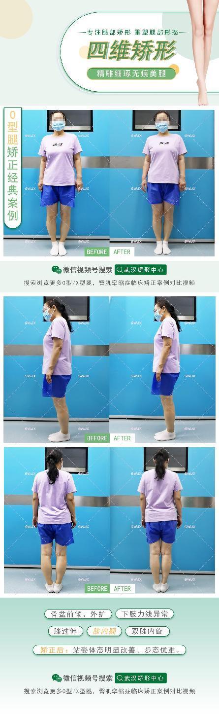 当心膝关节内翻！四维矫形技术治疗O型腿更有疗效