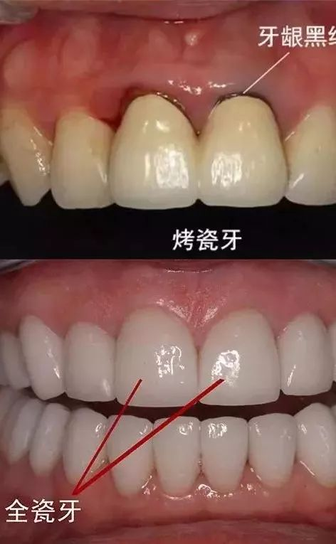 什么是全瓷牙？为什么医生都推荐做全瓷牙？一篇文章解答你的所有疑惑！