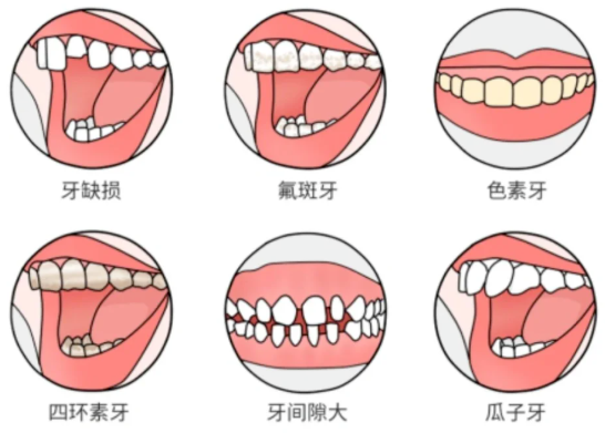 牙贴面选什么材质比较好？